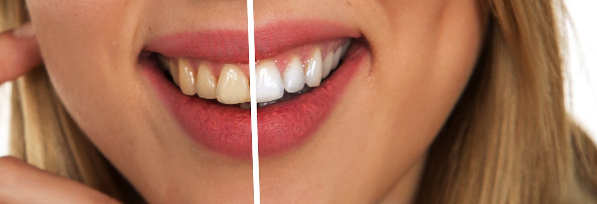 Whitening