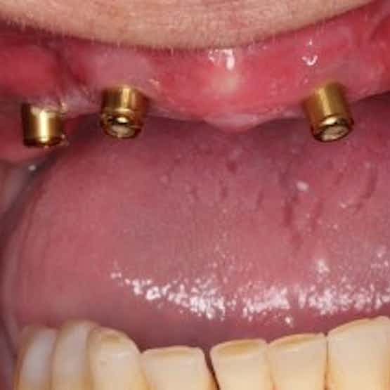 Implant Dentistry - Before image.