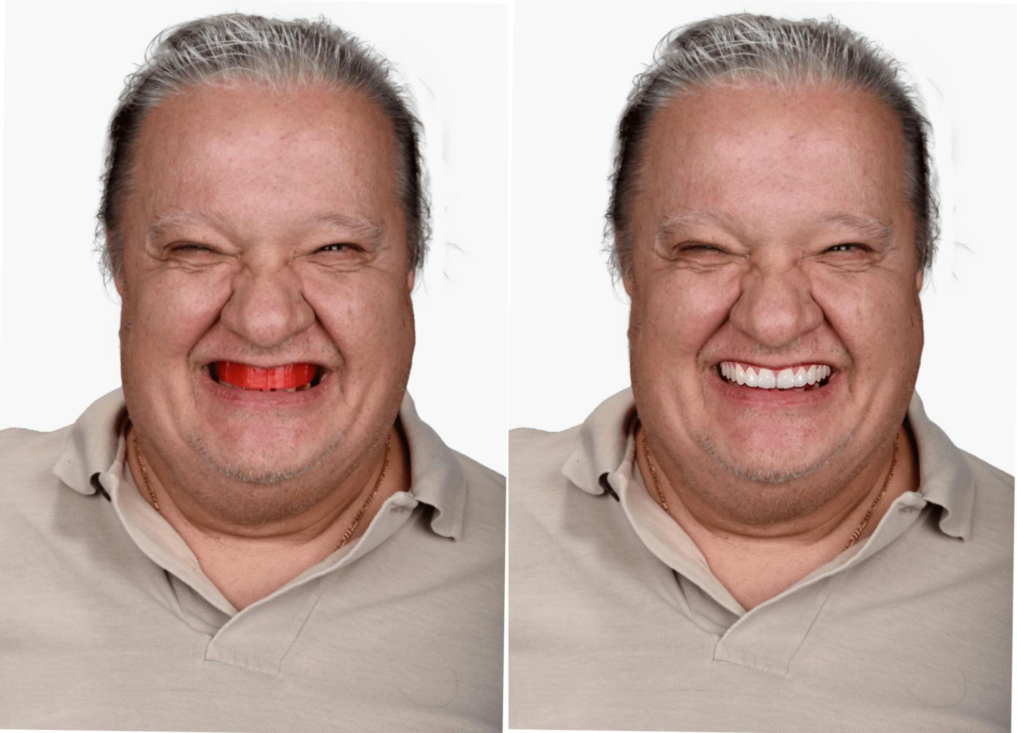 A Denture Patient with a  Wax Bite Rim