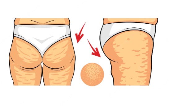 cellulite_reduction